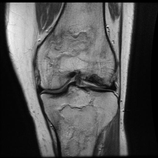 Knee AVN 1